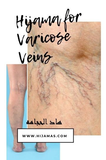 Hijama for varicose veins-varicose veins foot pain - varicose veins treatment near me-hijama for spider veins-