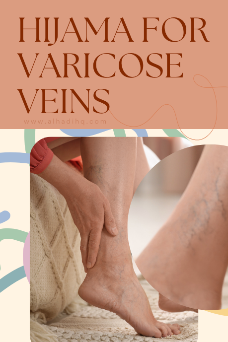 Cupping therapy varicose veins natural varicose veins treatment hyderabad varicose veins natural treatment