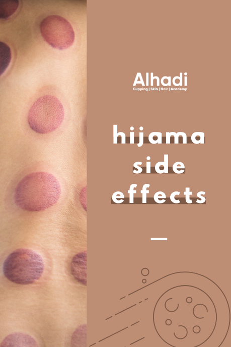 Cupping marks explained in detail -haad al hijama in hyderabad