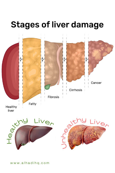 Alcohol fatty liver cure, alcoholic liver treatment, can i cure fatty liver, can you cure cirrhosis of the liver, can you cure fatty liver, can you cure liver disease, cause of fatty liver and treatment, cure for liver pain, cyst in the liver cure, fatty liver best treatment, fatty liver causes and cure, fatty liver cure how long does it take, fatty liver cure naturally, fatty liver cure treatment, fatty liver disease treatment diet, fatty liver healing, fatty liver medicine treatment, fatty liver natural treatment, fatty liver pain treatment, fatty liver symptoms in females treatment, fibrosis liver treatment, healing liver damage, healing your liver, how long does it take to cure a fatty liver, how to cure a fatty liver not caused by alcohol, how to cure fatty liver from alcohol, how to cure fatty liver naturally, how to cure liver cirrhosis, how to cure liver inflammation, liver autoimmune disease treatment, liver best medicine, liver cirrhosis natural cure, liver cirrhosis natural treatment, liver cyst treatment natural, liver infection treatment, liver inflammation treatment, liver lesions treatment, liver problem cure, liver radiation treatment, liver spots natural treatment, liver treatment natural, miracle cure for liver cirrhosis, natural detox your liver, natural liver detoxification, natural treatment liver problems, new treatment for fatty liver disease, non fatty liver disease treatment, polycystic liver treatment, treatment for enlarged liver and spleen, treatment for fatty liver in humans, treatment for liver fibrosis, treatment for liver infection, treatment for non alcoholic cirrhosis of the liver, treatment liver abscess, treatment liver pain, treatment of fatty liver, treatment of liver pain, what is the best treatment for liver cirrhosis, what is the fastest way to cure a fatty liver, what is the treatment for liver disease, what is the treatment of liver cirrhosis