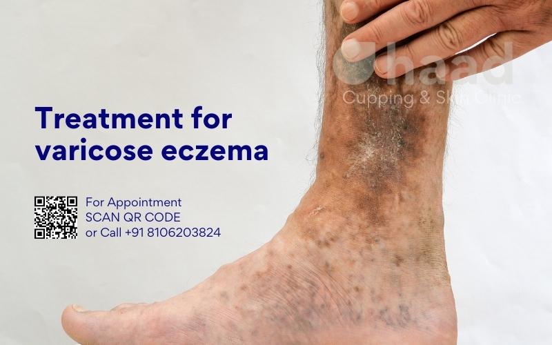 Treatment for varicose eczema