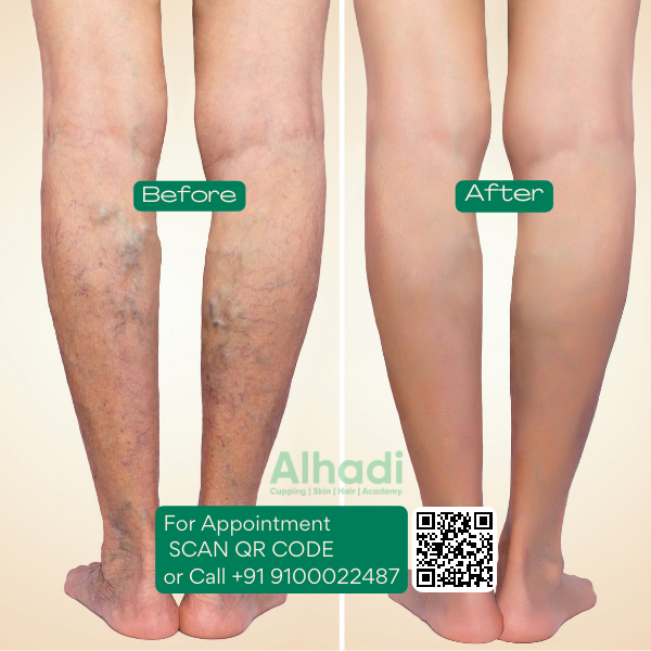 Best doctor for varicose veins in hyderabad,best doctor for varicose veins in india,best doctor for varicose veins near me,best treatment for varicose vein,best treatments for varicose veins,best varicose veins doctor in hyderabad,cure for varicose vein,cure for varicose veins,cure of varicose veins,doctor for varicose vein,hijama for varicose veins,hijama treatment for varicose veins,hijama varicose veins,how to treat varicose veins,is cupping therapy good for varicose veins,non surgical treatment for varicose veins,relieving varicose vein pain,treatment for varicose eczema,varicose doctor,varicose eczema treatment,varicose vein clinic hyderabad telangana,varicose vein doctors in hyderabad,varicose vein in telugu,varicose vein specialist in hyderabad,varicose vein treatment hyderabad,varicose vein treatment in hyderabad,varicose vein ulcer,varicose veins bodybuilding,varicose veins clinic hyderabad,varicose veins clinic in hyderabad,varicose veins doctor in hyderabad,varicose veins doctor in hyderabad,varicose veins doctors in hyderabad,varicose veins hands,varicose veins hospital in hyderabad,varicose veins hospital in hyderabad,varicose veins removal,varicose veins specialist doctor in hyderabad,varicose veins specialist doctor in hyderabad,varicose veins specialist in hyderabad,varicose veins specialist in hyderabad,varicose veins treatment hospitals in hyderabad,what are the causes of varicose veins,why varicose veins form