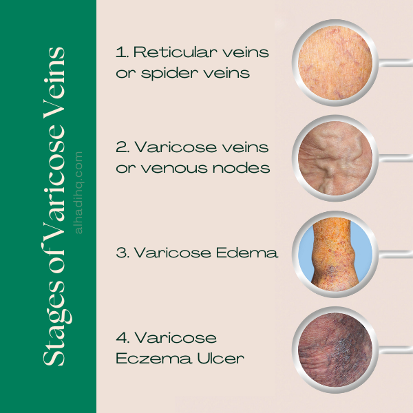 Best doctor for varicose veins in hyderabad, best doctor for varicose veins in india, best doctor for varicose veins near me, best treatment for varicose vein, best treatments for varicose veins, best varicose veins doctor in hyderabad, cure for varicose vein, cure for varicose veins, cure of varicose veins, doctor for varicose vein, hijama for varicose veins, hijama treatment for varicose veins, hijama varicose veins, how to treat varicose veins, is cupping therapy good for varicose veins, non surgical treatment for varicose veins, relieving varicose vein pain, treatment for varicose eczema, varicose doctor, varicose eczema treatment, varicose vein clinic hyderabad telangana, varicose vein doctors in hyderabad, varicose vein in telugu, varicose vein specialist in hyderabad, varicose vein treatment hyderabad, varicose vein treatment in hyderabad, varicose vein ulcer, varicose veins bodybuilding, varicose veins clinic hyderabad, varicose veins clinic in hyderabad, varicose veins doctor in hyderabad, varicose veins doctor in hyderabad, varicose veins doctors in hyderabad, varicose veins hands, varicose veins hospital in hyderabad, varicose veins hospital in hyderabad, varicose veins removal, varicose veins specialist doctor in hyderabad, varicose veins specialist doctor in hyderabad, varicose veins specialist in hyderabad, varicose veins specialist in hyderabad, varicose veins treatment hospitals in hyderabad, what are the causes of varicose veins, why varicose veins form