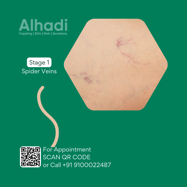 Varicose vein treatment hyderabad