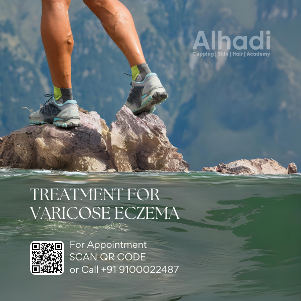 Best doctor for varicose veins in hyderabad, best doctor for varicose veins in india, best doctor for varicose veins near me, best treatment for varicose vein, best treatments for varicose veins, best varicose veins doctor in hyderabad, cure for varicose vein, cure for varicose veins, cure of varicose veins, doctor for varicose vein, hijama for varicose veins, hijama treatment for varicose veins, hijama varicose veins, how to treat varicose veins, is cupping therapy good for varicose veins, non surgical treatment for varicose veins, relieving varicose vein pain, treatment for varicose eczema, varicose doctor, varicose eczema treatment, varicose vein clinic hyderabad telangana, varicose vein doctors in hyderabad, varicose vein in telugu, varicose vein specialist in hyderabad, varicose vein treatment hyderabad, varicose vein treatment in hyderabad, varicose vein ulcer, varicose veins bodybuilding, varicose veins clinic hyderabad, varicose veins clinic in hyderabad, varicose veins doctor in hyderabad, varicose veins doctor in hyderabad, varicose veins doctors in hyderabad, varicose veins hands, varicose veins hospital in hyderabad, varicose veins hospital in hyderabad, varicose veins removal, varicose veins specialist doctor in hyderabad, varicose veins specialist doctor in hyderabad, varicose veins specialist in hyderabad, varicose veins specialist in hyderabad, varicose veins treatment hospitals in hyderabad, what are the causes of varicose veins, why varicose veins form