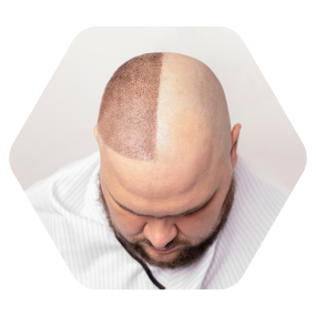 Hijama for hair loss hijama for hair hijama for alopecia hair and skin clinic hyderabad skin and hair clinic hyderabad hair doctor hyderabad hijama for hair fall best hair fall treatment in hyderabad hijama therapy for hair hair and skin clinic in hyderabad best hair and skin clinic in hyderabad cupping therapy for hair growth best hair clinic in hyderabad hijama for hair growth hair clinic hyderabad best hair treatment hyderabad hijama for baldness hair care hyderabad cupping for hair growth prp hair treatment in hyderabad hair fall treatment in hyderabad