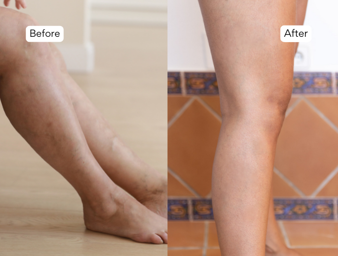 Heal spider veins naturally how to cure spider veins how to get rid of spider veins naturally natural ways to treat spider veins spider vein leg treatment spider vein natural treatment spider veins cure natural spider veins natural treatment spider veins treatment in hyderabad treatment for blocked veins in legs treatment for spider vein