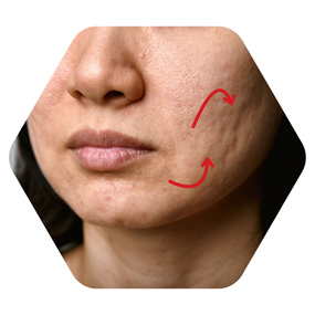 Acne scar treatment removal acne scar treatment skincare best acne scar treatment in hyderabad best dermatologist in hyderabad for acne scars laser treatment for acne scars in hyderabad