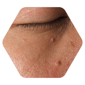 Skin tags eyelid removal skin tags removal on face skin tags under arms removal laser treatment to remove skin tags skin tag removal in hyderabad skin tags removal hyderabad skin tags removal treatment skin tags natural treatment skin tags on face treatment laser treatment for skin tags skin tags laser removal skin tags on neck removal skin tags under eyes removal skin tag removal hyderabad