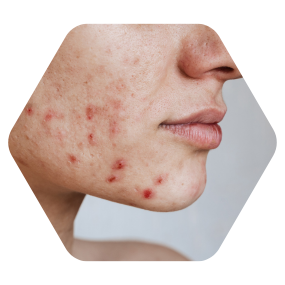 Best acne treatment in hyderabad cupping therapy for acne cupping therapy for acne hijama therapy for acne wet cupping for acne acne treatment hyderabad acne treatment in hyderabad best acne specialist hyderabad best acne treatment in hyderabad best dermatologist for acne in hyderabad best dermatologist in hyderabad for acne best doctor for acne in hyderabad dermatologist acne treatment in hyderabad cupping therapy for acne cupping therapy for back acne wet cupping for acne wet cupping therapy for acne